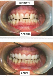 before-after-2