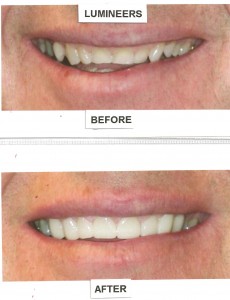 before-after-4